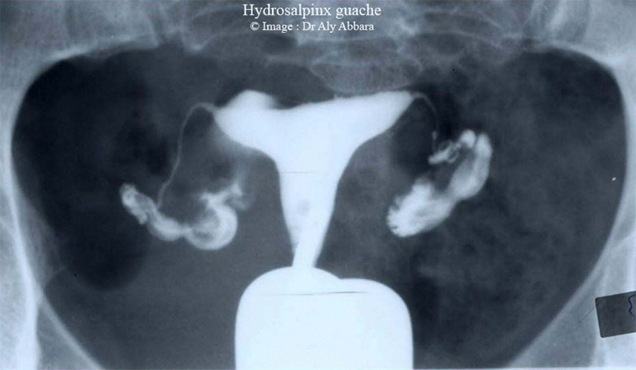 Hystérosalpingographie (HSG) - Hydrosalpinx gauche - S1
