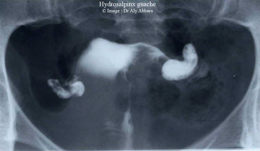 Hystérosalpingographie (HSG) - Hydrosalpinx gauche - S3