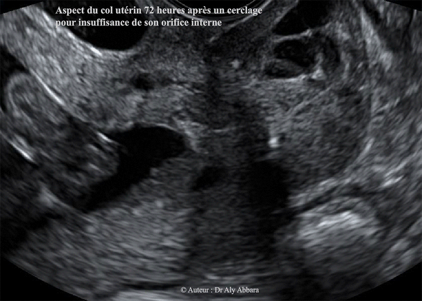 Incompétence de l'orifice interne du col utérin - Sévère menace d'avortement tardive à 18 SA - Aspect échographique du col utérin après un cerclage