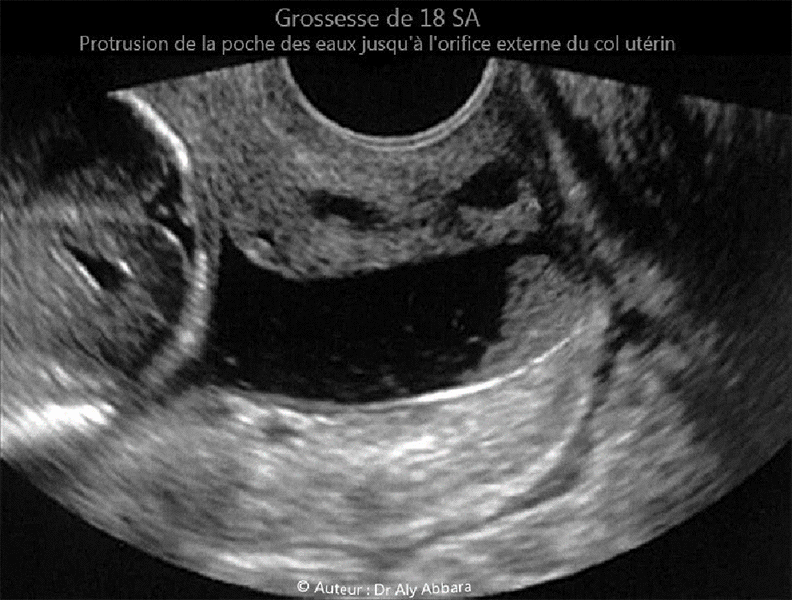 Incompétence de l'orifice interne du col utérin - Sévère menace d'avortement tardive à 18 SA - Echographie