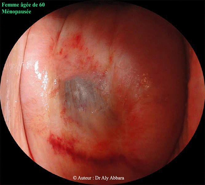 Obstruction de l'orifice externe du cervix chez femme ménopausée - Images clinique
