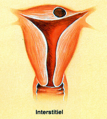 Fibrome cervical pédiculé et accouché par le col utérin