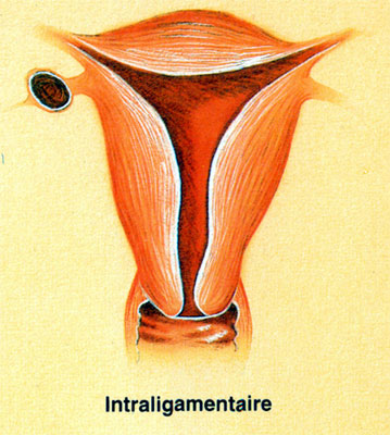 Fibrome cervical pédiculé et accouché par le col utérin