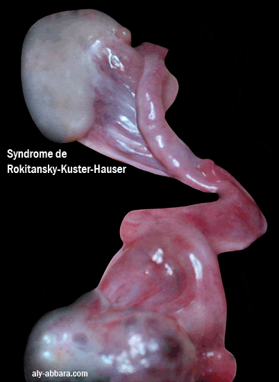 Les anomalies des organes génitaux internes dans le syndrome de Rokitanski-Kuster-Hauser