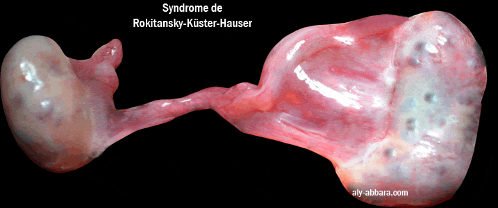 Les anomalies des organes génitaux internes dans le syndrome de Rokitanski-Kuster-Hauser