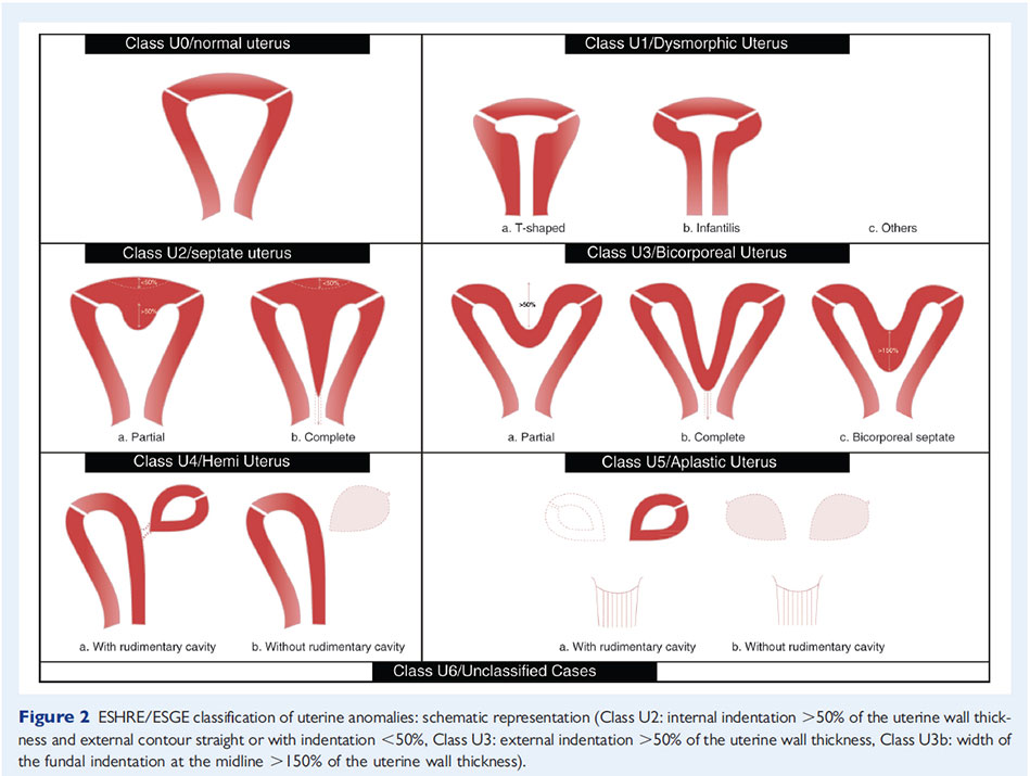 Classification des anomalies du tractus génital féminin selon l'ESHRE - ESGE - 2013