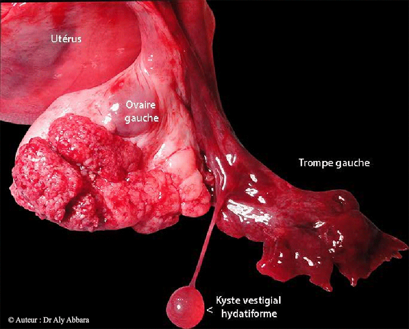 Tumeur (adénome) évoluant à la surface externe de l'ovaire gauche