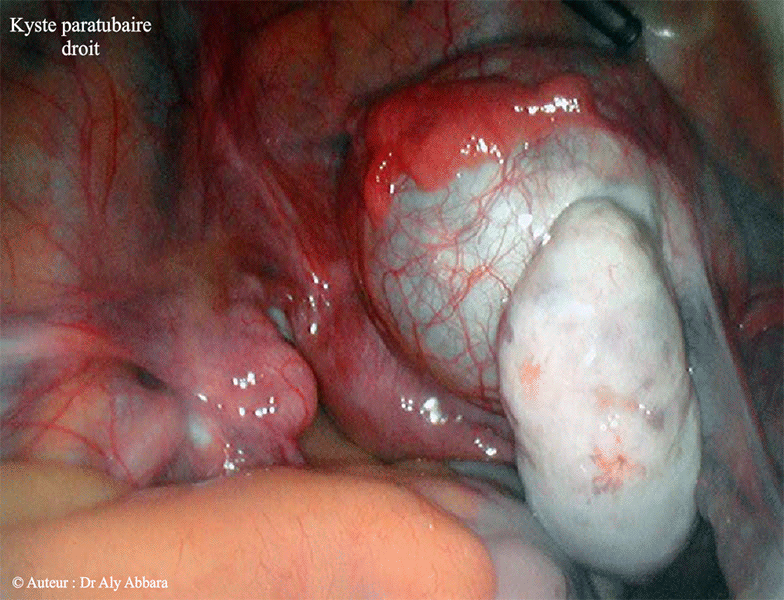 Kyste paratubaire droit - Image clinique coelioscopique