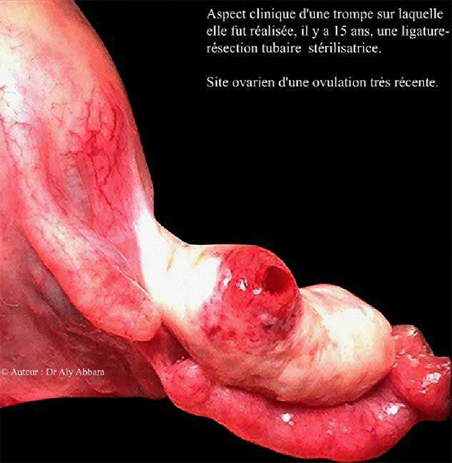 Image clinique montrant l'aspect d'une trompe après stérilisation par ligature resection tubaire - une ovulation récente dans l'ovaire homolatéral