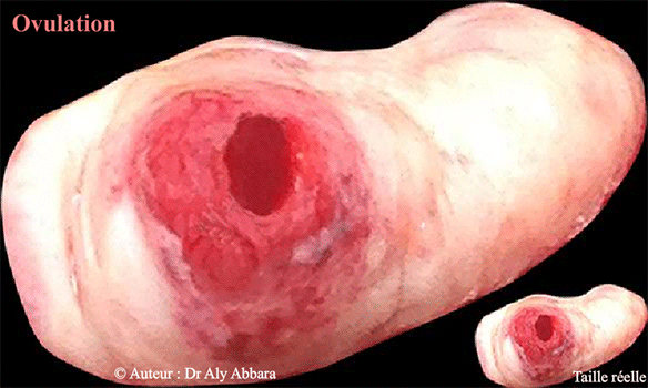 Site d'une ovulation récente survenant dans l'ovaire droit - Cratère post-ovulatoire - Image clinique