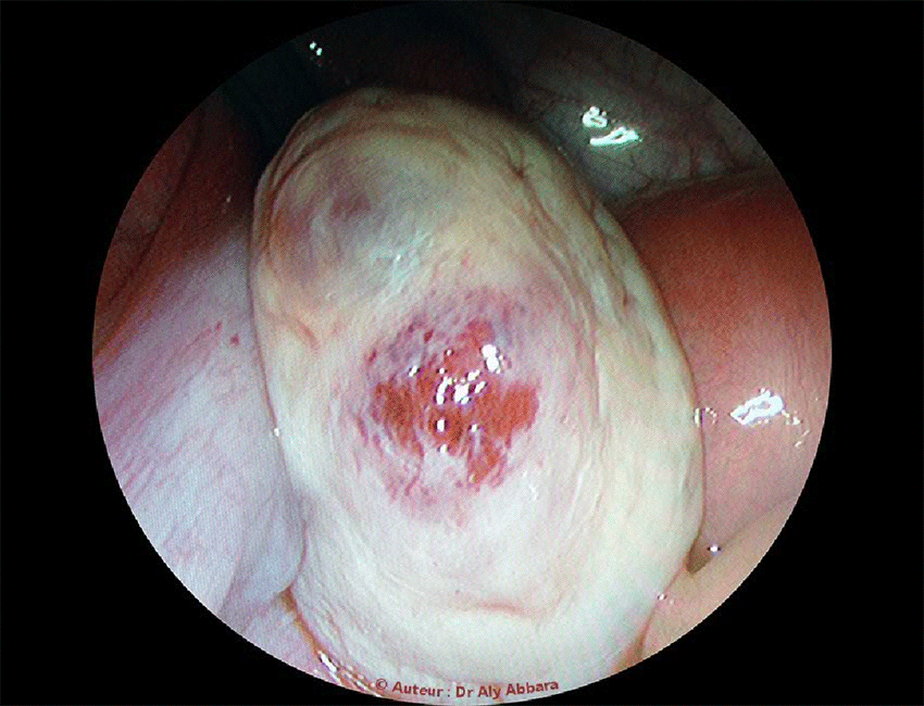 Image clinique coelioscopique montrant sur la surface de l'ovaire l'aspect de la cicatrice d'une ovulation récente