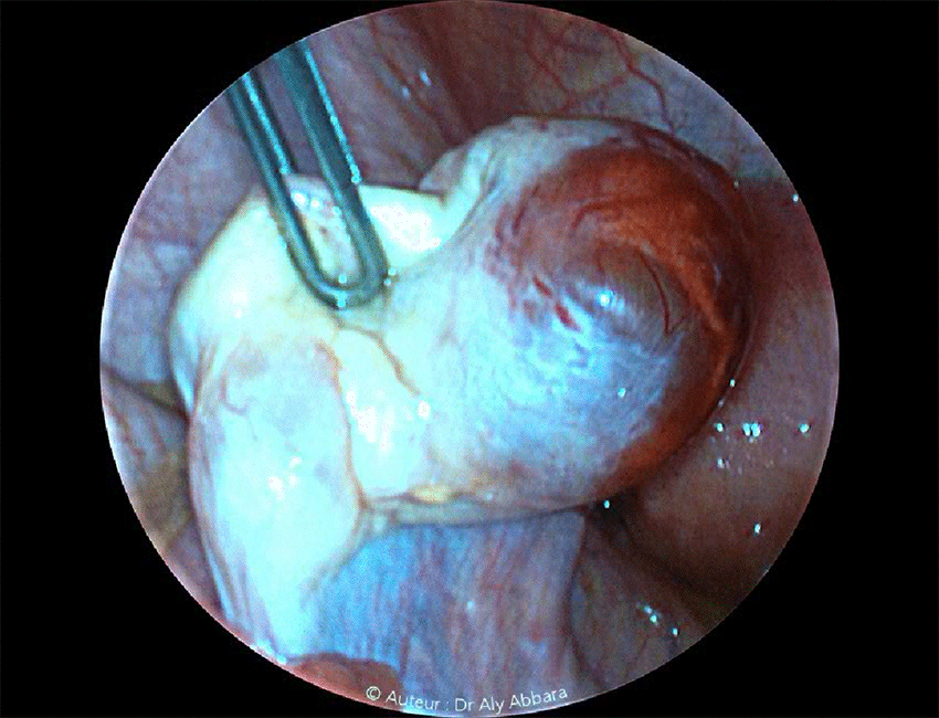 Ovaire gauche - Aspect clinique d'un follicule de Graaf en pré-ovulation