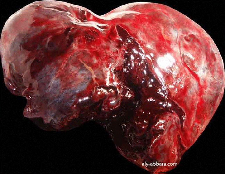 Hyperstimulation ovarienne compliquée d'une torsion et nécrobiose complète de l'ovaire - Image clinique