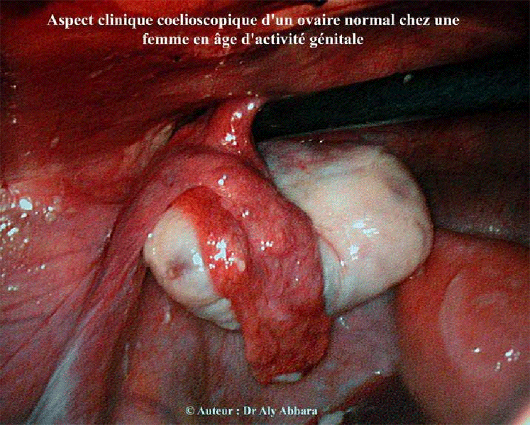 Ovaires normaux chez une femme en âge période d'activité génital - Images cliniques coelioscopiques