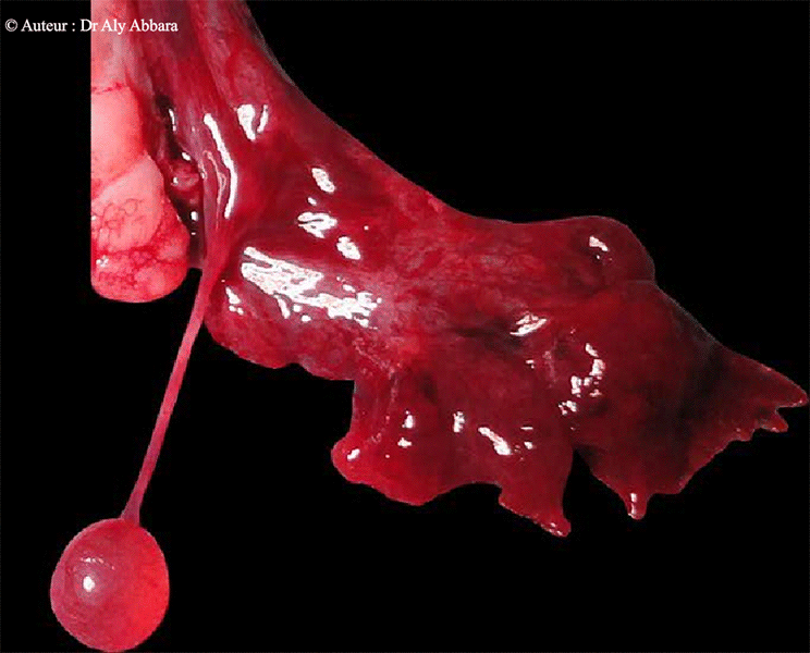 Appendice vésiculeux (Hydatide de Morgani) - Image clinique