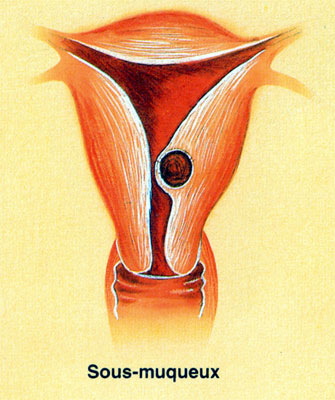 Fibrome cervical pédiculé et accouché par le col utérin