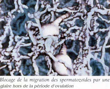 Blocage du passage des spermatozïdes par glaire endocervicale épaisse