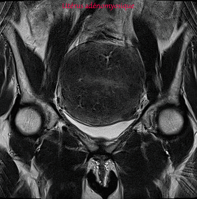 Utérus - Adénomyose florissante et petit myome sous séreux - IRM pelvienne