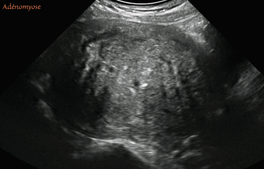 Utérus - Adénomyose florissante - images échographiques