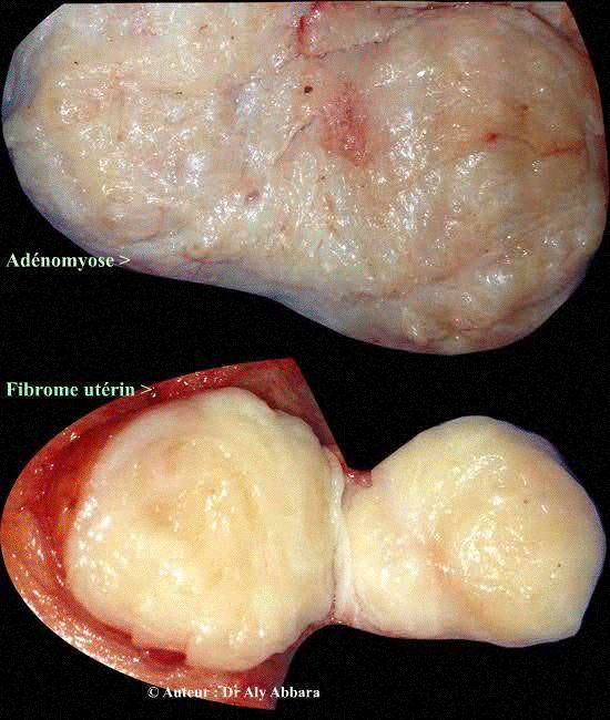 Images comparant l'aspect la différence entre l'aspect macroscopique d'uen adénomyose et d'un myome utérin