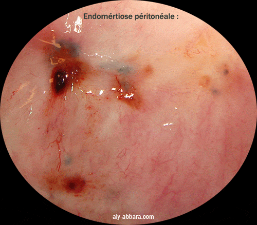 Un des aspects le plus fréquent de l'endométriose péritonéale