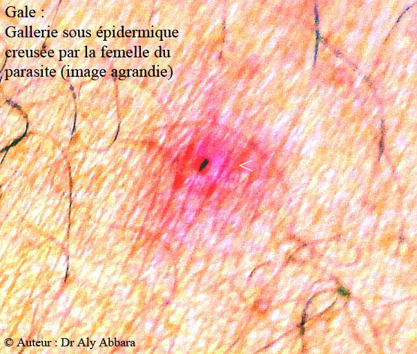 Gale : tunnel  intra-épidermique