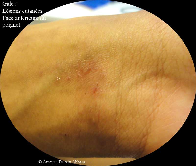 Gale : lésions cutanées à la face antérieure du poignet