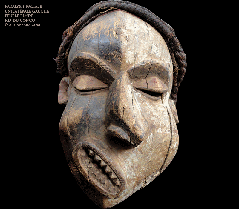 Masque représentant une face déformée par une paralysie faciale périphérique gauche - Sculpture du peuple Pendé - RD du Congo