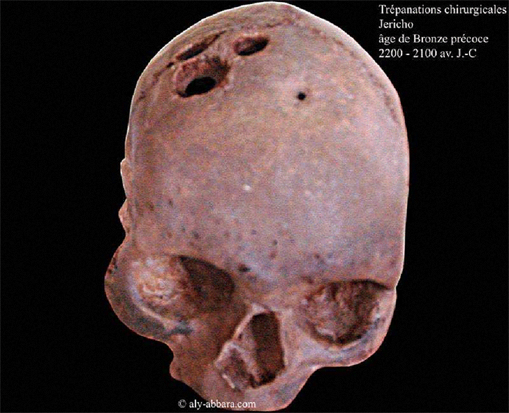 Crâne humain - Séquelles d'anciennes trépanations