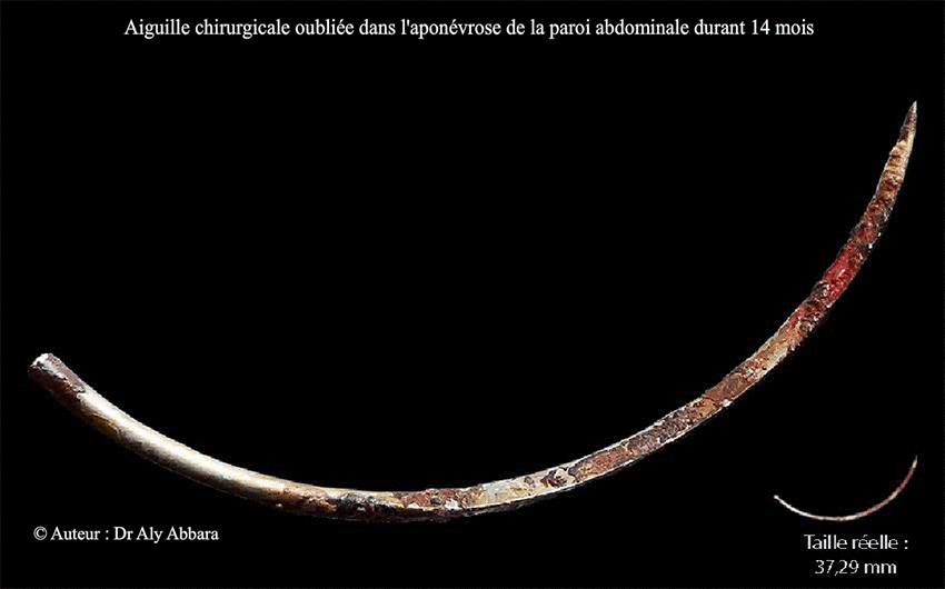 Aiguille oubliée dans le champs opératoire