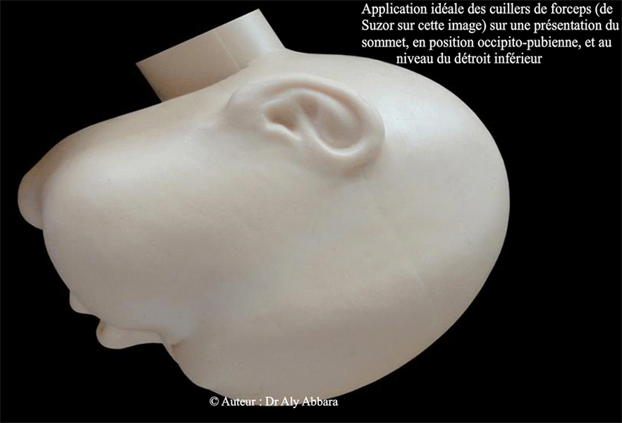 Forceps Suzor - Conseils d'application