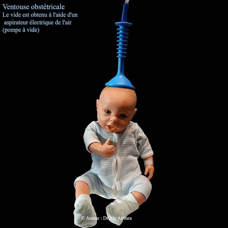 Ventouse obstétricale - Application sur manquin-enfant