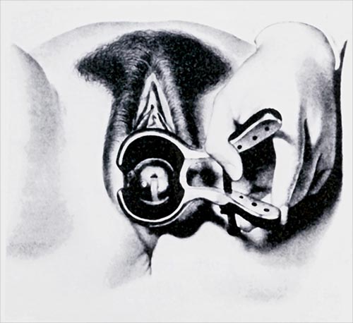 Ricord met en évdence la présence d'un ulcère syphilitique cervical après l'exploration du vagin par le spéculum qui porte son nom