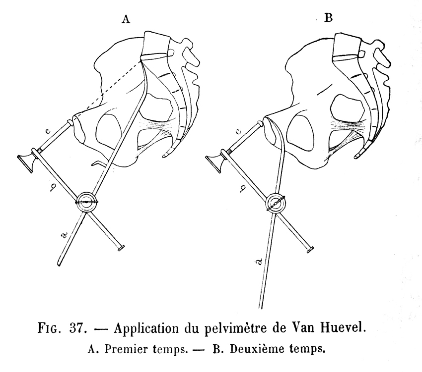 Applicateur du pelvimètre de Van Huevel